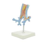 Modelo anatómico patológico del árbol bronquial sistema respiratorio con bronquitis y bronquiectasias