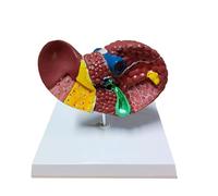 Modelo anatómico patológico del hígado a escala 1:1, sección abierta con lesiones tisulares, vasos sanguíneos y conductos biliares for la enseñanza médica