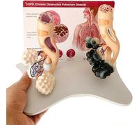 Modelo comparativo de alvéolos de fumadores y sanos, modelo anatómico alveolar humano, modelo de estructura alveolar ampliada, con tarjeta posterior en inglés