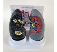 Modelo de anatomía broncopulmonar humana, comparación de fumar vs pulmón saludable, para educación médica y conferencias