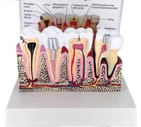 Modelo de anatomía de dientes humanos con problemas dentales comunes, modelo de dientes anatómicos de comparación de caries, demostración de enseñanza oral dental herramienta educativa