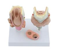 Modelo de anatomía de la laringe con patología tiroidea Humana, Herramienta Detallada de enseñanza médica y demostración para la comunicación médico-Paciente y Fines de investigación