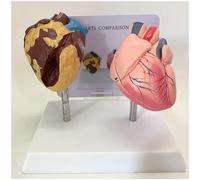 Modelo de anatomía de órganos humanos Modelo de corazón, Modelo de comparación de corazón fumador y corazón normal - Modelo de corazón médico for exhibición de estudio Modelo médico de enseñanza