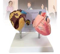 Modelo de anatomía del corazón, modelo comparativo entre un corazón fumador y un corazón normal, adecuado para el aprendizaje, la exposición y la enseñanza de medicina.