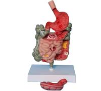Modelo de anatomía del estómago humano, modelo de patología intestinal, modelo de sistema digestivo patológico, modelo de enseñanza extraíble, sección del estómago, modelo médico de anatomía