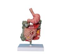 Modelo de anatomía del estómago humano Modelo de sistema digestivo patológico, for demostración en el aula, modelo de enseñanza extraíble