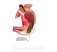 Modelo de anatomía del estómago Modelo de Gastritis Modelo de lesión gástrica - Demostración de Enfermedades gástricas Sistema digestivo Humano Enseñanza médica Modelo anatómico