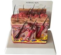 Modelo de anatomía del folículo piloso de la piel humana ampliado, pústula inflamada, proceso de crecimiento y desarrollo humano, for herramienta de ayuda a la formación médica