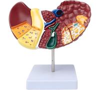 Modelo de anatomía del hígado humano, modelos patológicos de lesión del tejido hepático con base y textura clara y patológico, presenta un modelo de cáncer de hígado for demostración didáctica.