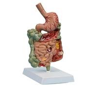 Modelo de anatomía del sistema digestivo patológico, estómago desmontable e intestino delgado, for la educación paciente