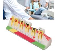 Modelo De Anatomía Dental con Caries, Modelo Anatómico Comparativo Dientes con Caries con Etiquetas Codificadas por Colores, Que Muestra Todo El Proceso Desarrollo De La Caries