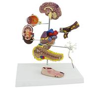 Modelo de anatomía Modelo de anatomía, anatomía Humana - Modelo de Diabetes patológica órgano diabético, complicación cirugía de neurona pancreática Cerebral - Ayuda médica educativa, 8 Part