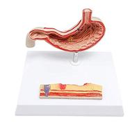Modelo de anatomía Modelo de anatomía de úlcera gástrica - Modelo de anatomía del estómago - Modelo anatómico médico Enfermo del estómago Órgano Humano - para la enseñanza de Estudios médico