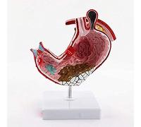 Modelo de anatomía Modelo de anatomía del estómago, Modelo médico de lesión gástrica Humana 1: 1 Modelo patológico de anatomía del estómago. Herramientas Esenciales para la gastroenterología