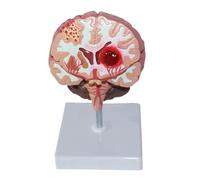 Modelo de anatomía patológica del cerebro humano: infarto cerebral, hemorragia y trastorno vascular. Exhibición for la enseñanza neurociencia
