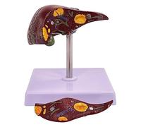 Modelo de anatomía patológica del hígado de tamaño Natural, 2 Piezas Desmontables para Modelos de enseñanza comunicación médico-Paciente