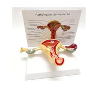 Modelo de anatomía patológica del útero y los ovarios con órganos extraíbles. Aparato reproductor femenino detallado con fibromas. Humana Modelo