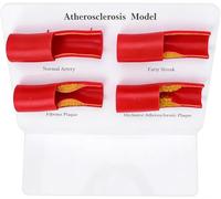 Modelo de aterosclerosis humana, modelo de visualización anatómica patológica de la arteria de 4 etapas, utilizado for la enseñanza médica y demostración de fisiología del sistema