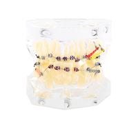 Modelo de brackets, modelo de dientes de estudio Ortodoncia modelo de maloclusión duradera Modelo de dientes de cadena de alambre, tratamiento de maloclusión para estudiar, enseñar,