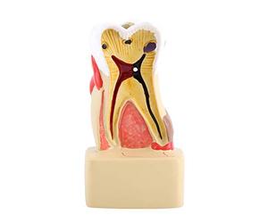 Modelo de caries modelo de diente de enfermedad de dentista patológico Dental con nervio para la enseñanza del dentista escolar