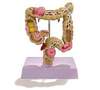 Modelo de colon, modelo de patología de colon a tamaño real 1:1, modelos de estudio anatómico del sistema digestivo e intestino grueso para educación médica, consultorios médicos y aulas.(Small)