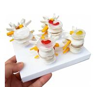 Modelo de columna lumbar humana, 4 etapas de patología, muestra hernia de disco, degeneración ósea y disco, osteoporosis avanzada, para educación médica