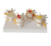 Modelo de columna vertebral humana: comparación de columna lumbar enferma de 4 etapas para educación de anatomía y fisiología