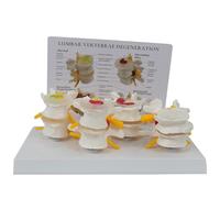 Modelo De Columna Vertebral Humana Con Tarjeta Trasera En Inglés, Modelo De Vértebras Lumbares De 4 Etapas, Muestra Hernias Discales, Degeneración Ósea Y Discal Y Osteoporosis Avanzada, Para