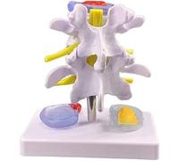 Modelo de columna vertebral humana: demostración anatómica de hernia discal lumbar for uso educativo.