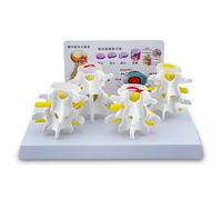 Modelo de columna vertebral humana, modelo de columna lumbar humana de 4 etapas con características patológicas que muestran hernia discal, degeneración ósea y discal, y osteoporosis avanzada.