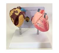 Modelo de comparación de corazón humano fumador y corazón sano