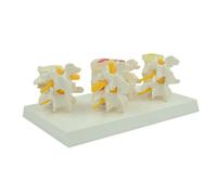 Modelo de Comparación de la Columna Lumbar con Enfermedad en 4 Etapas Desmontable con Tarjeta Posterior en Inglés, Modelo de Columna Vertebral Humana para Herramienta Didáctica