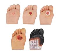 Modelo de cuidado de pies diabéticos, modelo de cambios patológicos de úlceras de pie, simulador de pie diabético 1-5, placa de pie graduada para pies diabéticos, para anatomía, fisiología