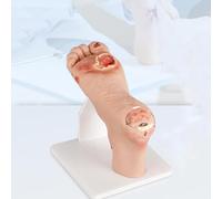 Modelo de cuidado del pie diabético, incluye lesiones purulentas de heridas grado 1-5, placa de pie graduada para entrenamiento de anatomía y fisiología(Mild Disease 1~3level)