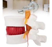 Modelo de demostración de columna lumbar de anatomía humana 1:1.5, modelo de hernia de disco lumbar, modelo anatómico de columna vertebral humana, modelo de hernia de disco lumbar