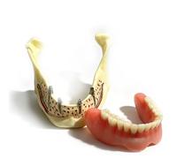 Modelo de descomposición dental mandibular, demostración de sobredentadura sobre implantes, modelo anatómico para enseñanza y experimentos de investigación médica.