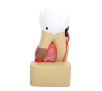 Modelo de diente de enfermedad Modelo de caries de dentista dental Modelo de educación dental con nervio para la enseñanza del dentista