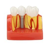 Modelo De Diente, Modelo de implante Dental con Corona y Puente extraíbles, Adecuado para demostración en el Aula y formación de Estudiantes de odontología