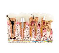 Modelo de Diente Patológico Modelo de Dientes de Enseñanza Dental Modelo del Nervio del Diente para Comunicarse con los Pacientes Modelo de Síntomas Comunes de los Dientes