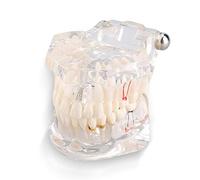 Modelo de diente transparente Dental Implante Enfermedad Dientes Modelo Adulto Typodont Demostración Dientes Modelo para Enseñanza y Estudio