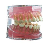 Modelo de dientes de implante dental, con goma blanda y dientes de resina extraíbles extraíbles para práctica y enseñanza