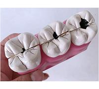 Modelo De Dientes De Patologías - Modelo De Anatomía De Los Dientes De Caries - Lecciones De Dientes Modelo Patológico De Caries Dental En Dientes Enfermos - Para Lecciones De Demostración De Práctica