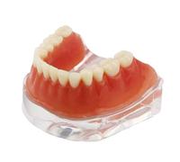 Modelo de Dientes de sobredentadura dentales Modelo de restauración Dental con 4 implantes Demostración de implantes de precisión Inferior de sobredentadura, Modelo de Dientes de Estudio de enseñanza