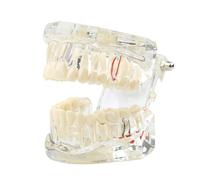 Modelo de dientes enfermedad transparente dental implante Demostración análisis estándar diente entrenamiento tipodont con puente corona extraíble for educación estudiantes (azul)(Clear)