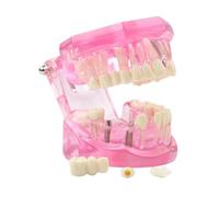 Modelo de dientes enfermedad transparente dental implante Demostración análisis estándar diente entrenamiento tipodont con puente corona extraíble for educación estudiantes (azul)(Pink)