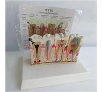 Modelo de dientes humanos, modelo oral patológico, manifestación dental de escritorio con tabla de explicación, modelo anatómico de caries dental para aula de ciencias.
