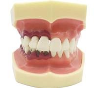 Modelo de dientes patológicos periodontales con encía removible, modelo de demostración de educación del paciente dental for dentistas y comunicación de enseñanza oral