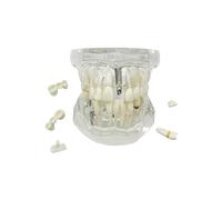 Modelo de dientes transparentes para enfermedades, YOUYA DENTAL transparente, modelo de dientes de implante dental, dentista, enfermedad estándar, diente extraíble, modelo de enseñanza patológica