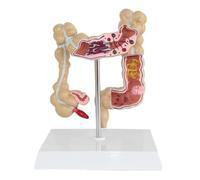 Modelo de enfermedad colorrectal humana Anatomía Patológica Enfermedad del colon Medicina intestinal Enseñanza anatómico