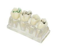 Modelo de Enseñanza de Caries Dentales Abs para Demostración Oral